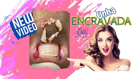 Unha encravada? Não sofra mais!! #unhaencravada #podologia #nails #ingrown_toenail