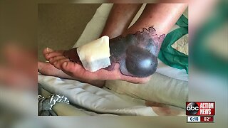 Ohio man contracts flesh-eating bacteria in Tampa Bay, nearly loses foot