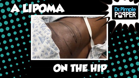 A Grammy Winning Lipoma