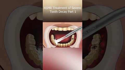 SATISFYING ASMR ( TREATMENT OF SEVERE TOOTH DECAY) @Satisfying_ ASMR _Animations