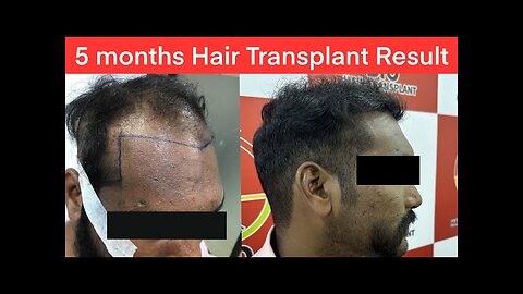 5 Months Hair Transplant Result