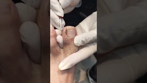 Big ingrown toenail #shorts