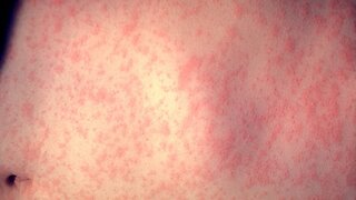 Number Of US Measles Cases Reaches Highest Level Since 1992