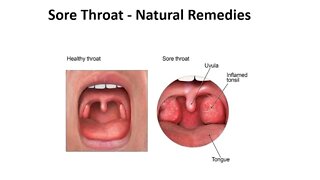 Sore Throat - Causes & Natural Treatment