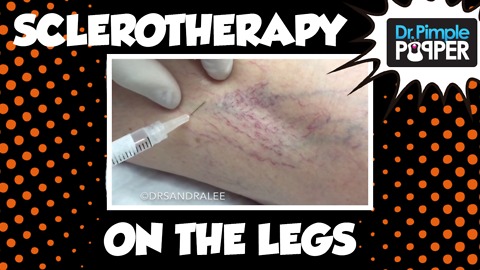 Sclerotherapy (treating spider veins) on the legs.