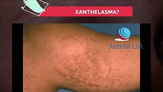 WHAT IS XANTHELASMA