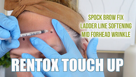 Rentox Touch Up // Correcting Spock Brow & Ladder Lines