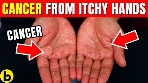 Woman’s ‘Itchy Hands’ Turned Out To Be Sign Of Rare Terminal Cancer