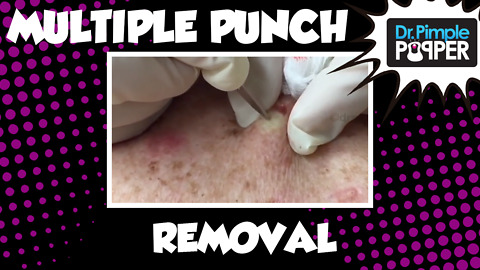Multiple punch removals of Cysts on the Back & Blackhead Extractions