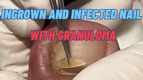 Ingrown and Infected Nail with Granuloma