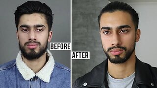 How I Cured My Acne (5 EASY STEPS)