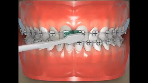How to brush while braces on Teeth| how to clean teeth #braces #orthodontics