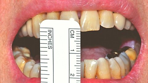 How to Root Canal in Tight Spaces (limited opening)