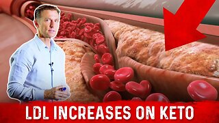 Cardiologist (Dr. Nadir Ali) Explains LDL Bad Cholesterol Spike With Keto – Dr.Berg