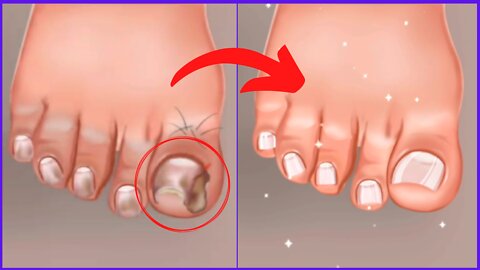 Foot Finger Surgery Treatment - Body and Beauty