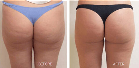 Cellulite Gone- No Weight Loss No Gym Routine