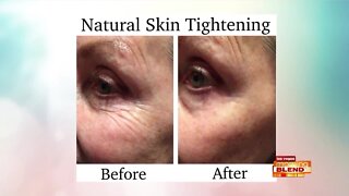 Skin Tightening Without Surgery