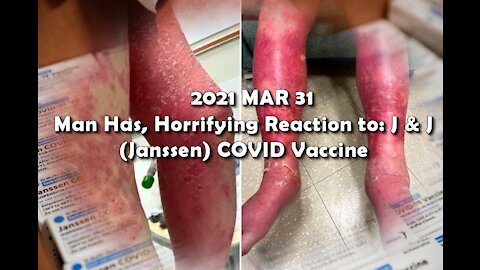 2021 MAR 31 Man Has, Horrifying Reaction to Johnson and Johnson COVID Vaccine