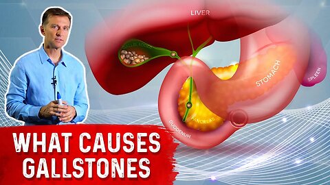 What Really Causes Gallstones? - Dr. Berg
