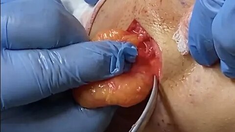 Removal of a medium sized soft lipoma at the base of the neck
