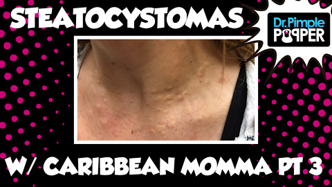 Caribbean Momma & Her Steatocystomas! Session One, Part Three