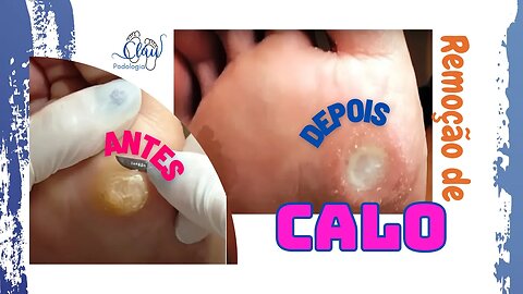 Remoção de calos enormes #unhaencravada #podologia #nails #ingrown_toenail