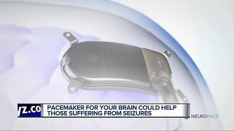 Pacemaker for your brain could help those suffering from seizures