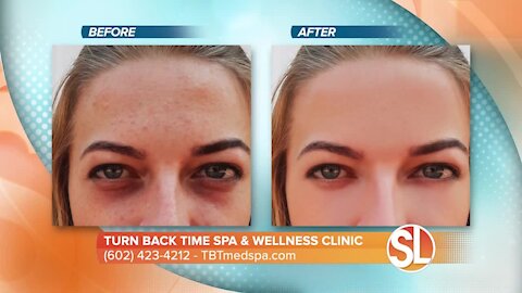 Watch how Turn Back Time Spa & Wellness Clinic can remove dark spots, age spots and much more from your skin