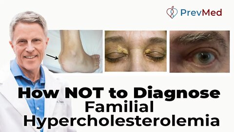 How NOT to Diagnose Familial Hypercholesterolemia