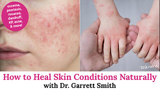 How to Heal Skin Conditions Naturally with Dr. Garrett Smith