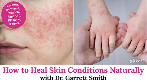 How to Heal Skin Conditions Naturally with Dr. Garrett Smith