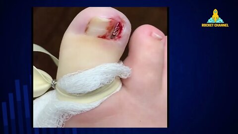 VERY PAINFUL INGROWN TOENAIL - FOOT CARE - REMOÇÃO DE UNHA ENCRAVADA