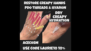Restoring My Creapy Hands With PDO