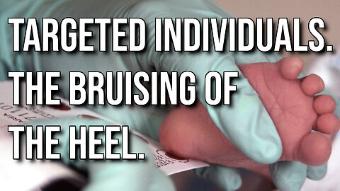TARGETED INDIVIDUALS. THE BRUISING OF THE HEEL.
