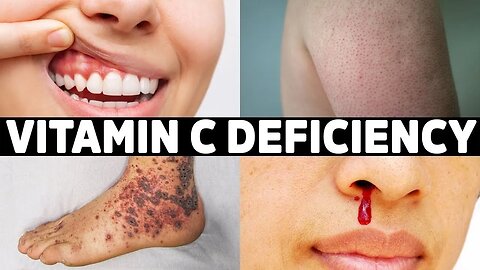 The 7 Signs You're Not Getting Enough Vitamin C