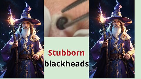 Stubborn blackheads