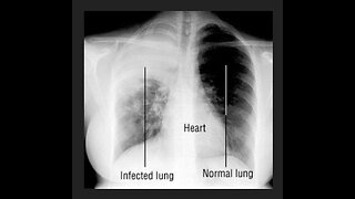 White Lung Syndrome