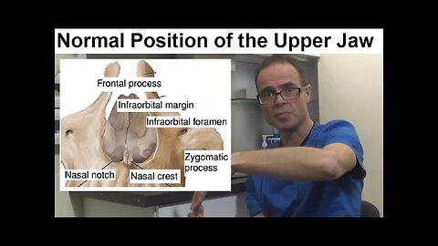 What is the Normal Position Posture of the Upper Jaw Maxilla or Palate by Dr Mike Mew