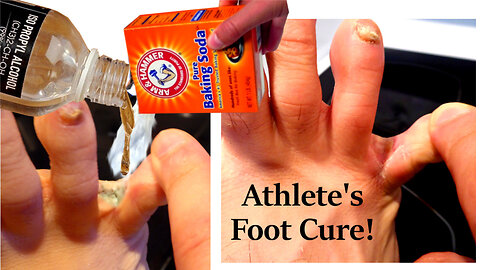 👣 Athlete's Foot Part 3: Baking Soda + Rubbing Alcohol = CURE?? I Think So!