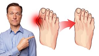 How to Fix Bunions in 3 Steps