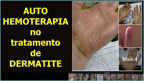 APÓS 6 ANOS DE SOFRIMENTO SOMENTE A AUTO-HEMOTERAPIA RESOLVEU