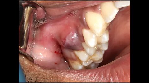 Juicy Pus Explosion from Dental Abscess with Extraction