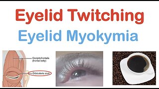 Eyelid Twitching (Eyelid Myokymia) | Triggers, Pathophysiology, Symptoms, Diagnosis, Treatment