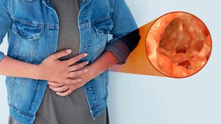 5 Complications of Diverticulitis You Should Know About