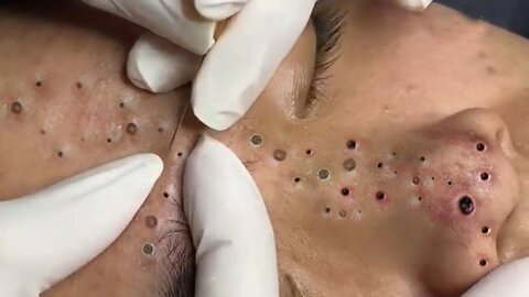 Blackheads, Blackhead Removal, Acne Extraction Relaxing #58