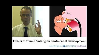 Effects of Thumb Sucking on Dento-Facial Development by Dr Mike Mew