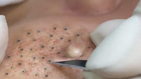 Removing Acne and Blackheads Treatment, #42
