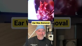 Most Satisfying Ear Wax Removal 😍 #shorts