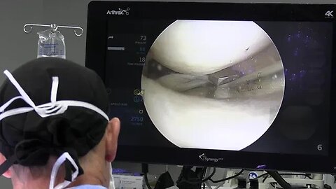 Scott A. Barbour, M.D. walks through a Knee Arthroscopy