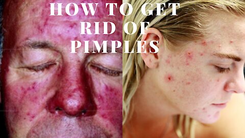 How To Get Rid Of Pimples: 6 Overnight DIY Remedies To Try At Home.